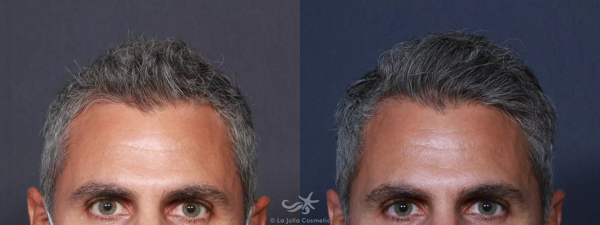Before & After Hair Restoration Result 18 Front View in San Diego, CA