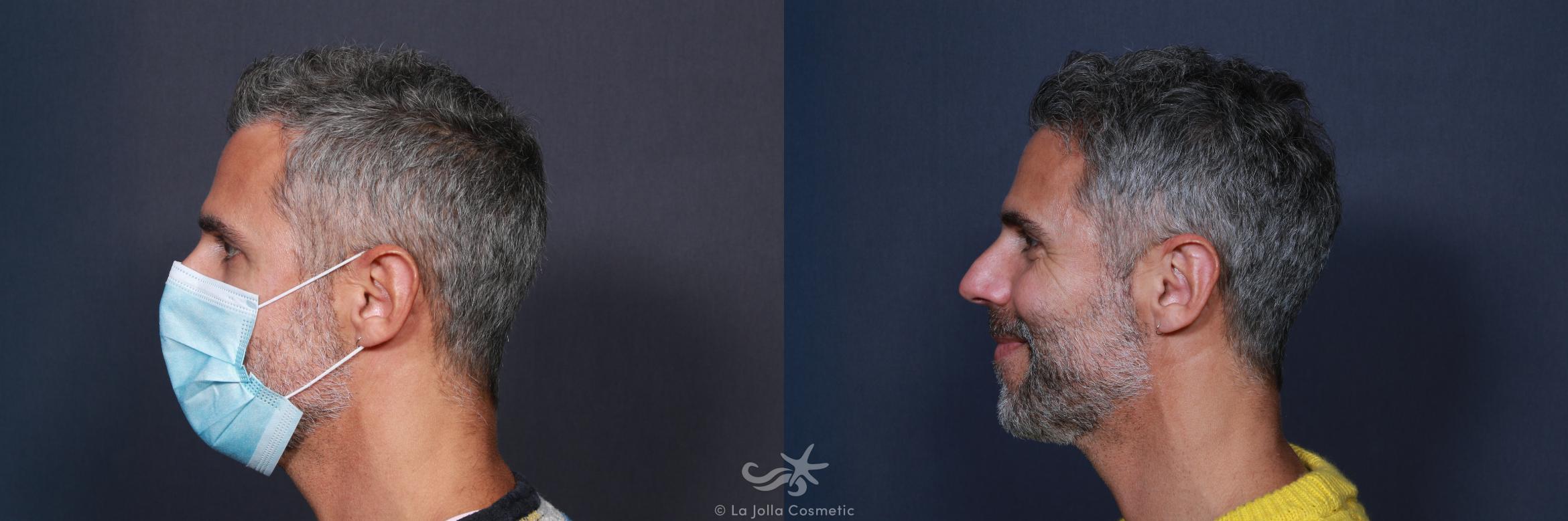Before & After Hair Restoration Result 18 Left Side View in San Diego, CA