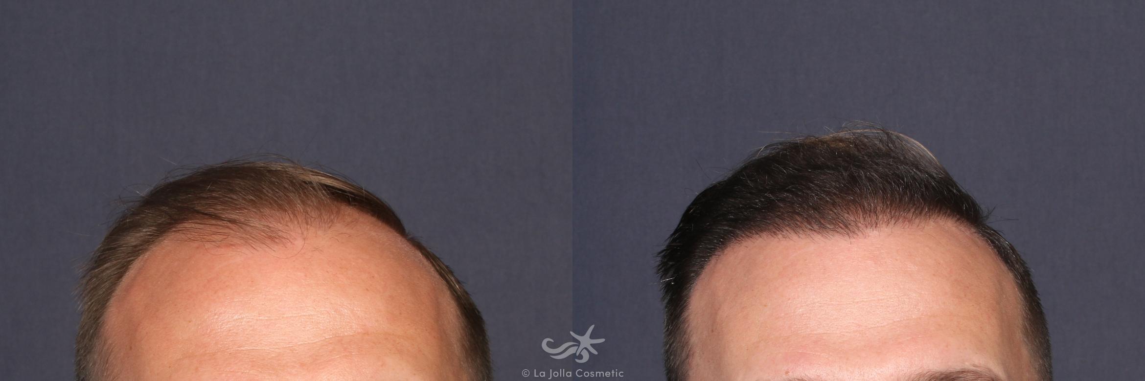 Before & After Hair Restoration Result 210 Front View in San Diego, CA