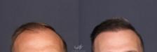 Before & After Hair Restoration Result 210 Front View in San Diego, Carlsbad, CA