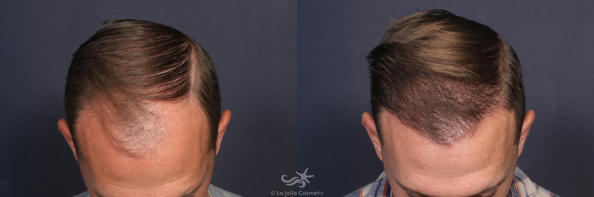 Before & After Hair Restoration Result 210 Top View in San Diego, CA