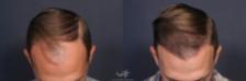 Before & After Hair Restoration Result 210 Top View in San Diego, Carlsbad, CA