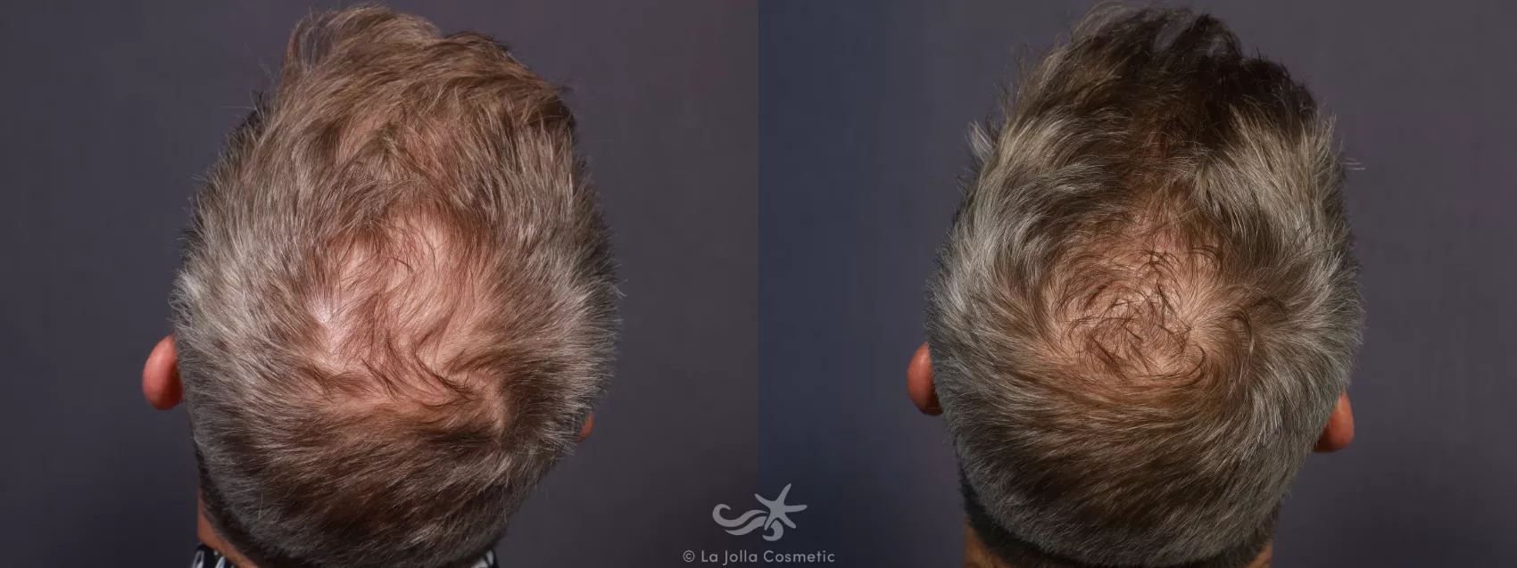 Before & After Hair Restoration Result 724 Birds Eye View in San Diego, CA