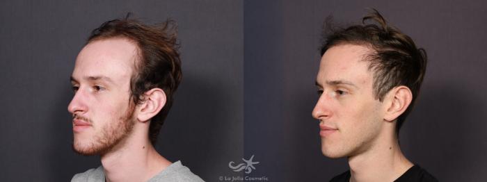 Before & After Hair Restoration Result 754 Left Oblique View in San Diego, Carlsbad, CA