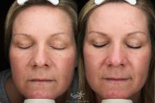 Before & After HALO™ Laser Treatment Result 114 Front View in San Diego, Carlsbad, CA