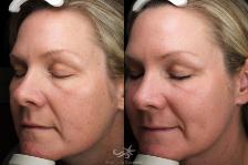 Before & After HALO™ Laser Treatment Result 114 Left Oblique View in San Diego, Carlsbad, CA