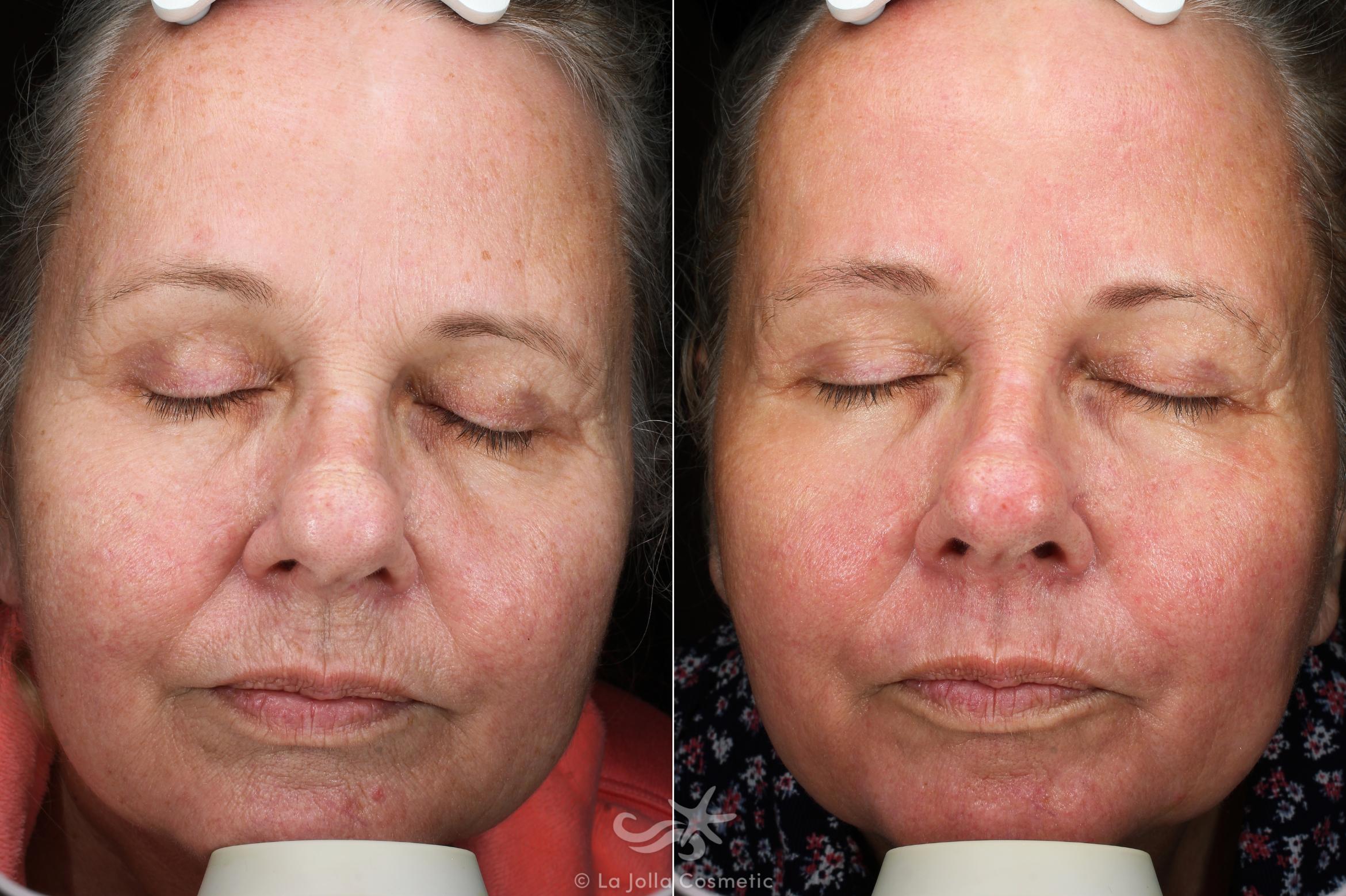 Before & After HALO™ Laser Treatment Result 535 Front View in San Diego, CA