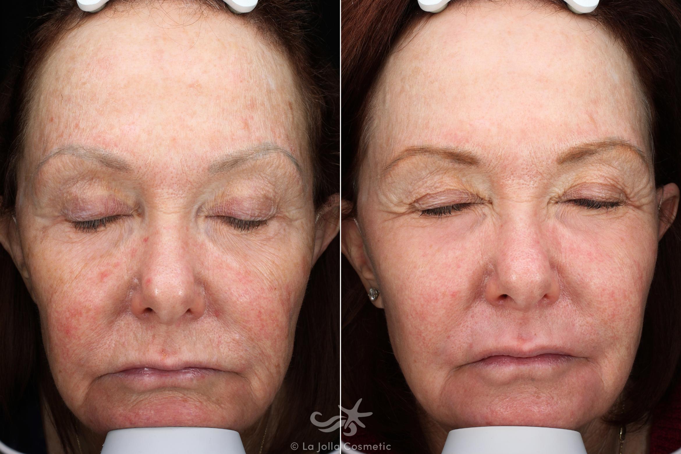 Before & After Laser Treatments Result 539 Front View in San Diego, CA
