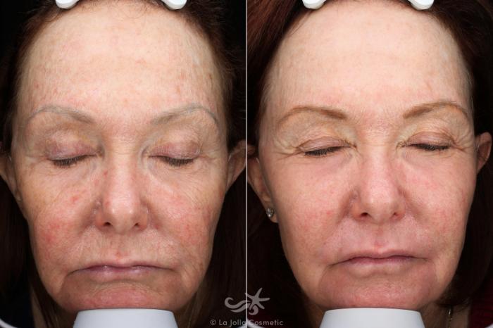Before & After HALO™ Laser Treatment Result 539 Front View in San Diego, Carlsbad, CA