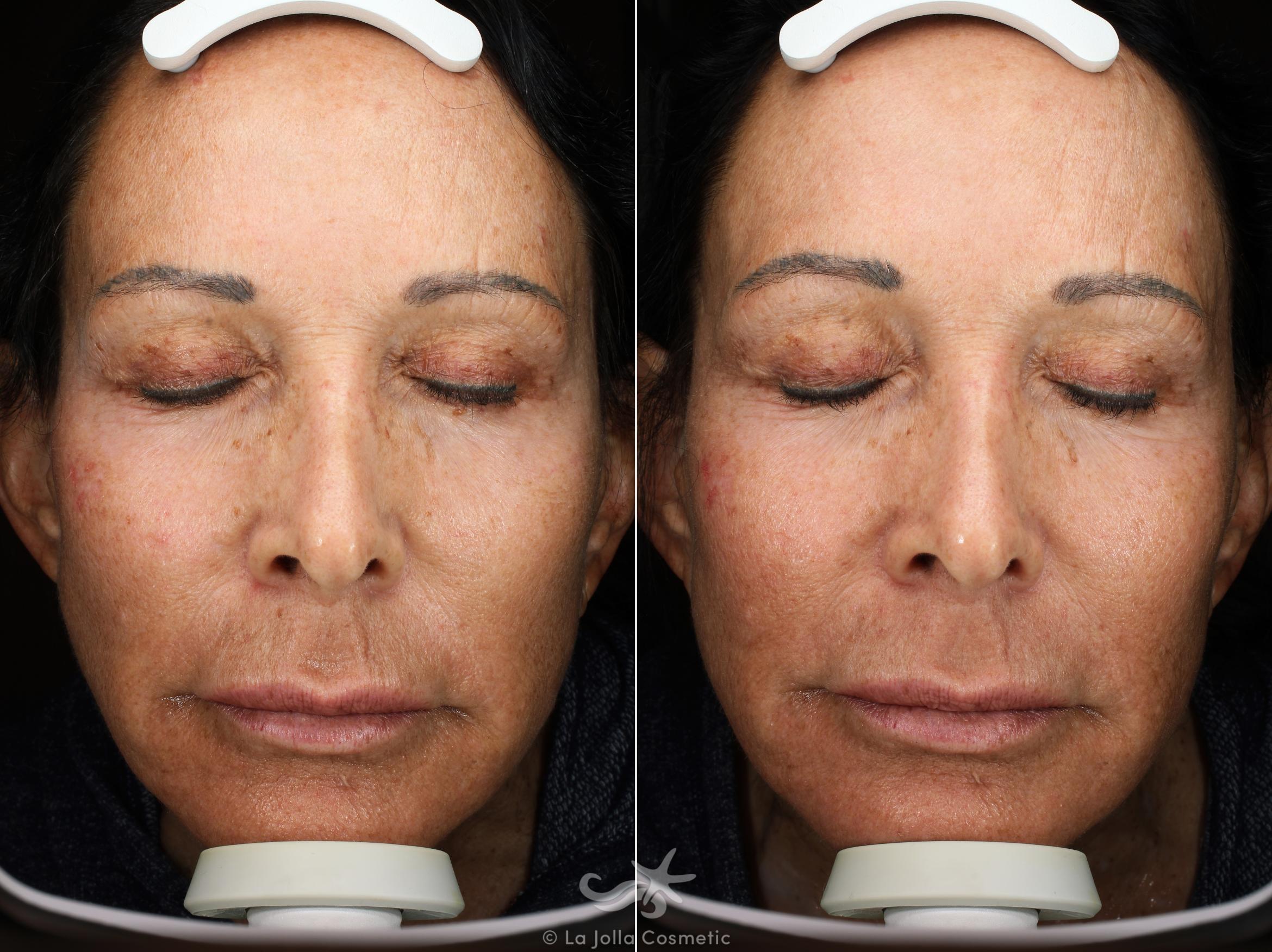 Before & After HALO™ Laser Treatment Result 541 Front View in San Diego, CA