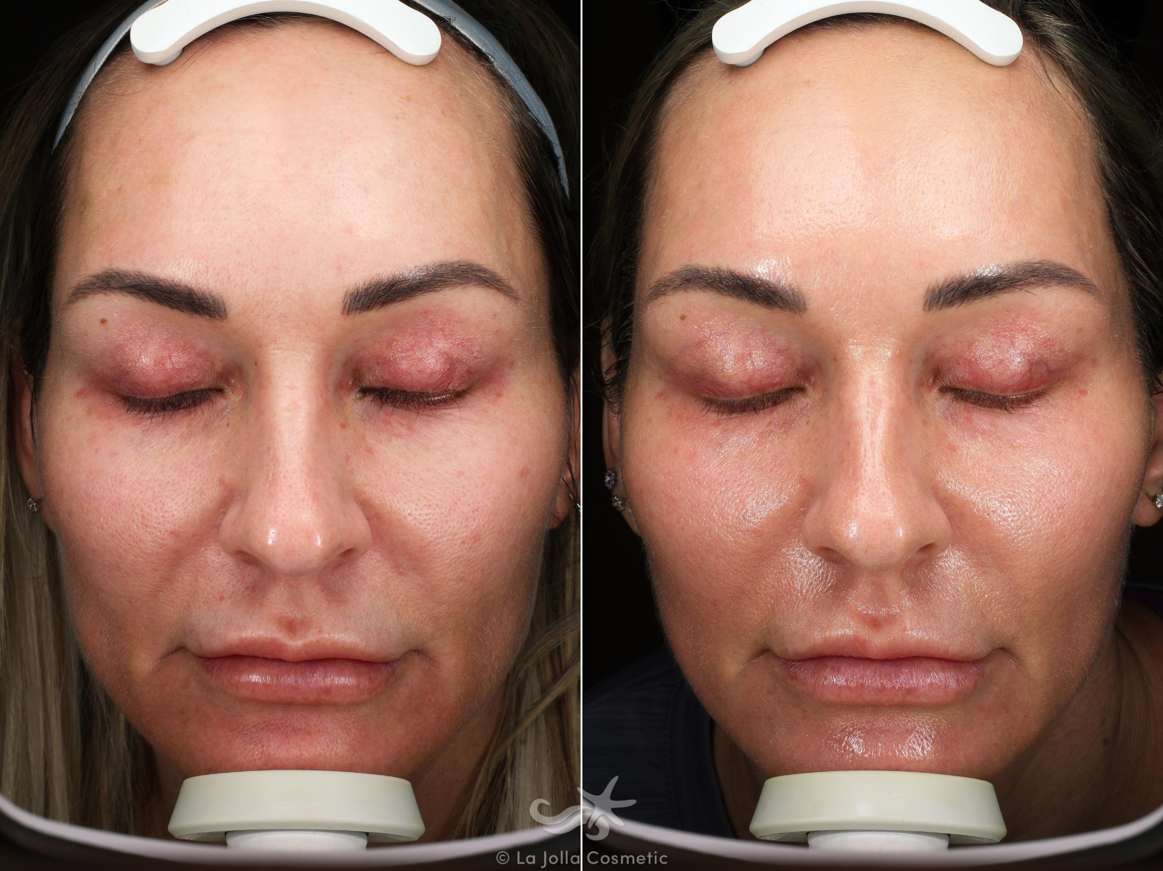 Before & After HALO™ Laser Treatment Result 542 Front View in San Diego, CA