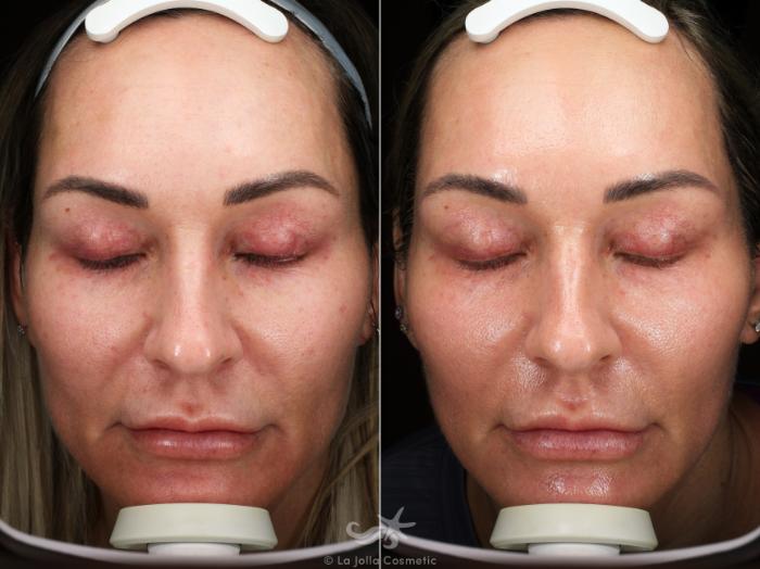 Before & After HALO™ Laser Treatment Result 542 Front View in San Diego, Carlsbad, CA