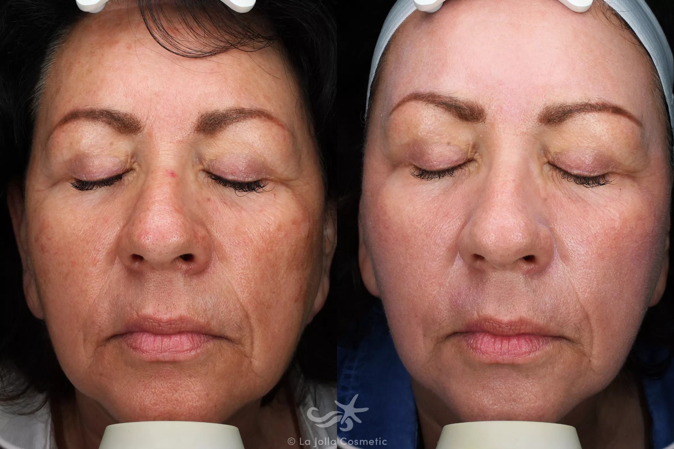 Before & After HALO™ Laser Treatment Result 545 Front View in San Diego, CA
