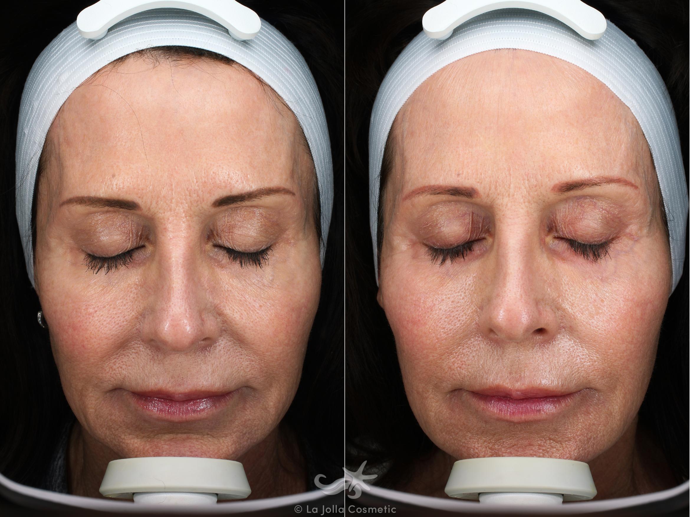 Before & After Laser Treatments Result 546 Front View in San Diego, CA