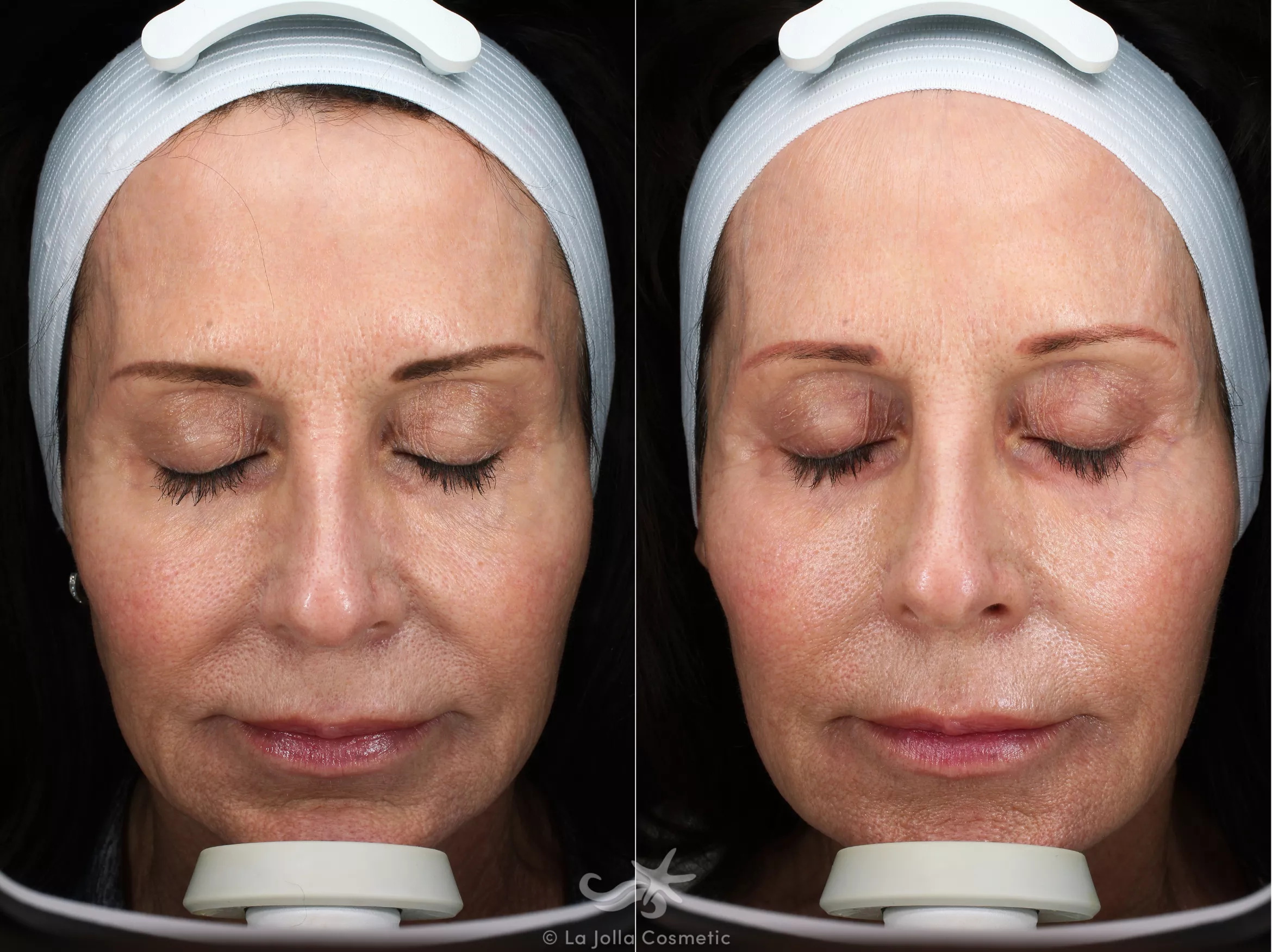 Before & After HALO™ Laser Treatment Result 546 Front View in San Diego, CA