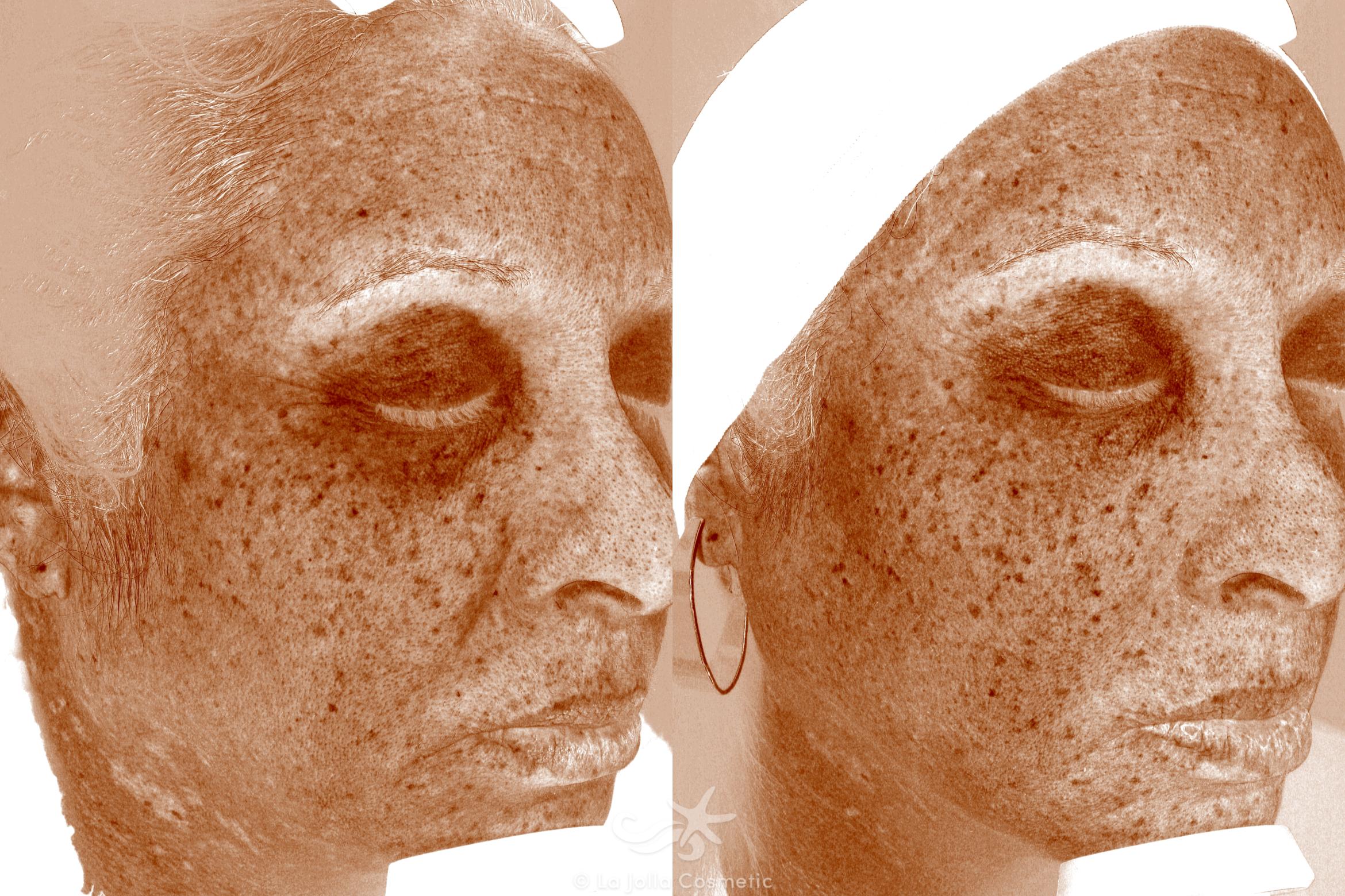 Before & After HALO™ Laser Treatment Result 641 Brown Spots Right Side View in San Diego, CA