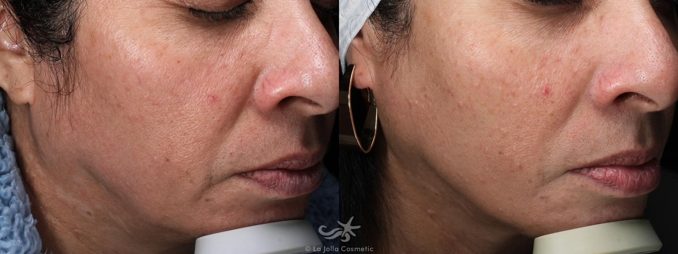 Before & After JUVÉDERM® Result 641 Right Side View in San Diego, CA