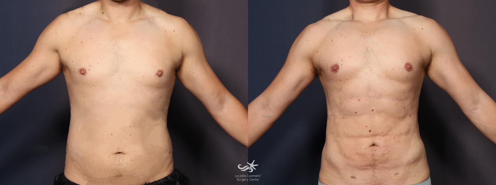 Before & After High Definition Liposuction Result 1086 Front View in San Diego, CA