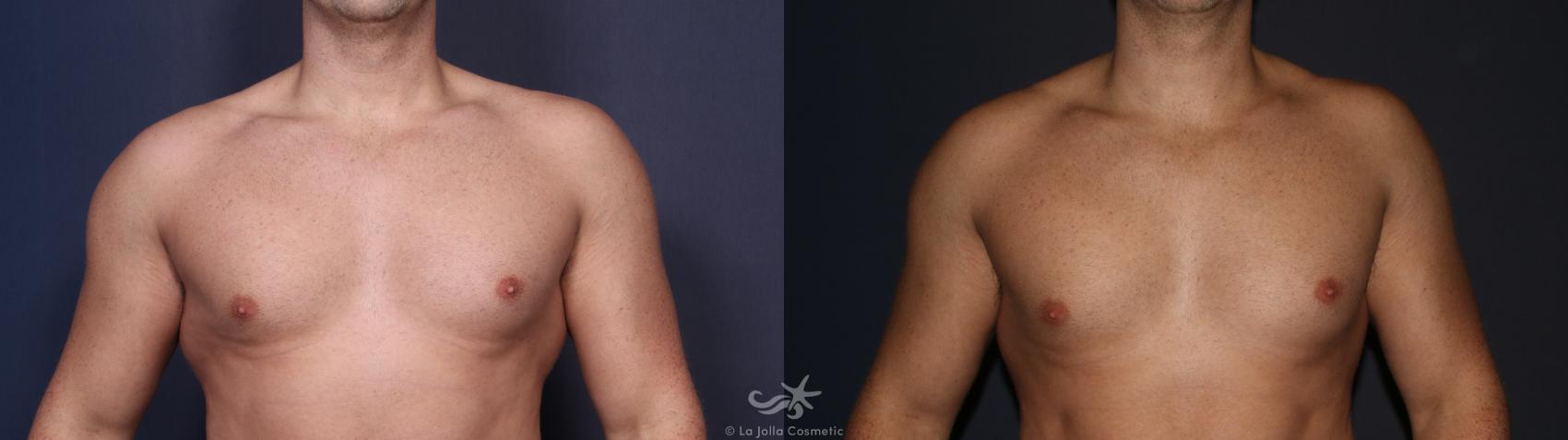 Before & After High Definition Liposuction Result 125 Front View in San Diego, CA
