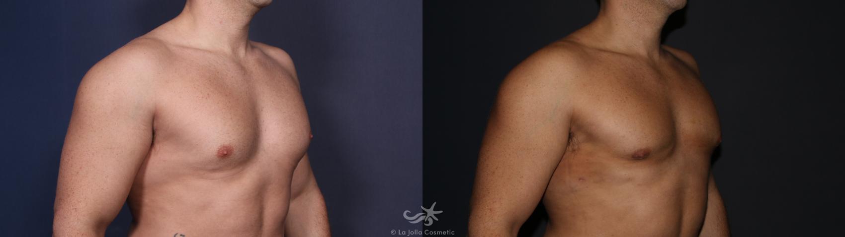 Before & After High Definition Liposuction Result 125 Right Oblique View in San Diego, CA