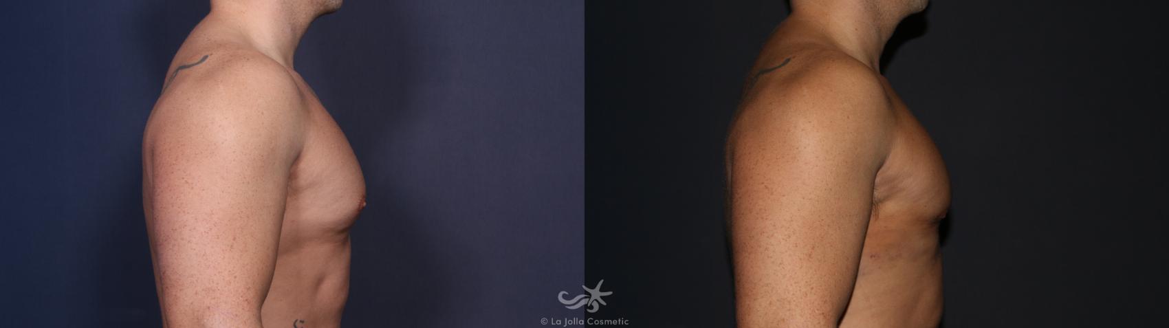 Before & After High Definition Liposuction Result 125 Right Side View in San Diego, CA