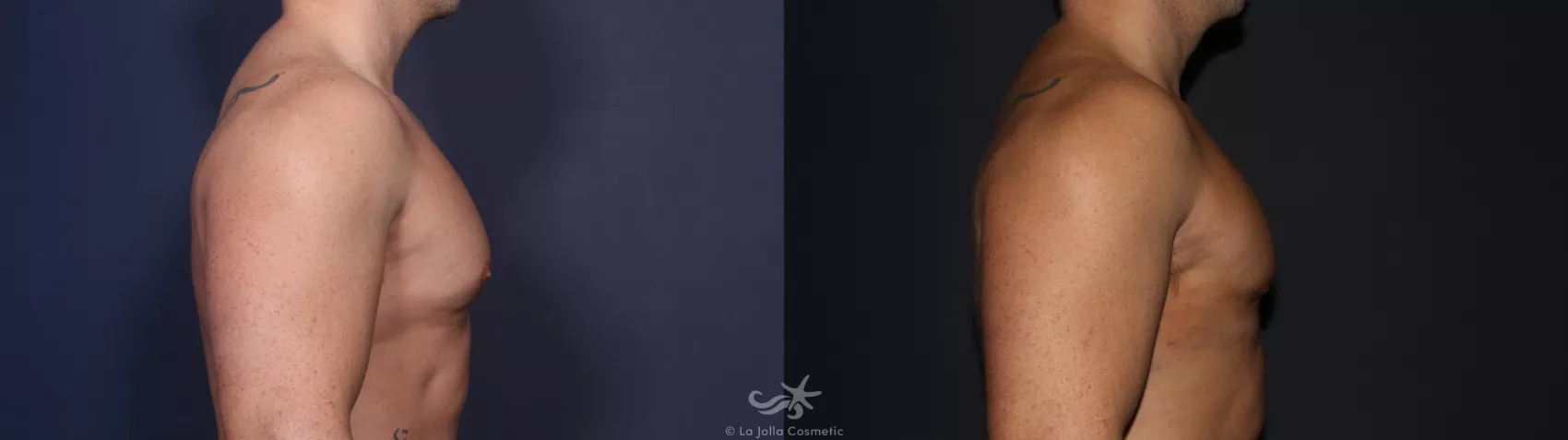 Before & After High Definition Liposuction Result 125 Right Side View in San Diego, CA