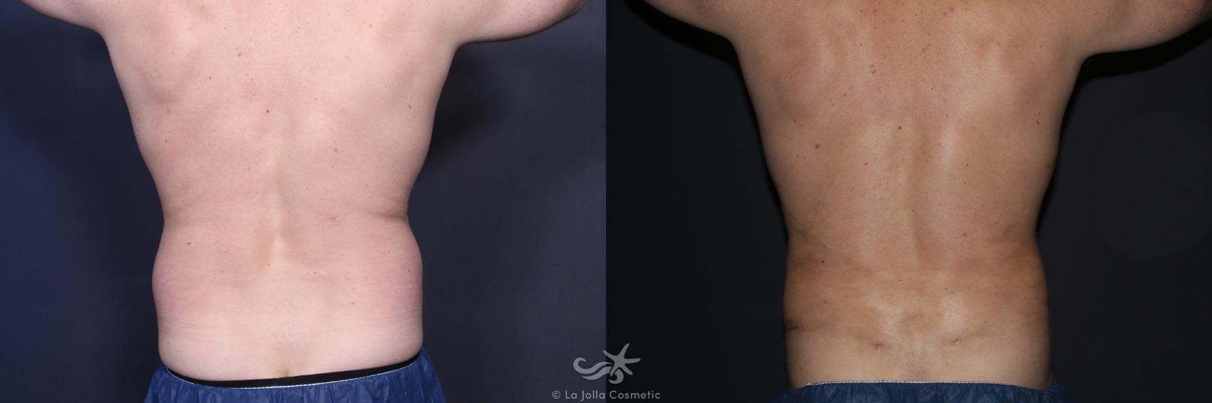 Before & After High Definition Liposuction Result 132 Back View in San Diego, CA