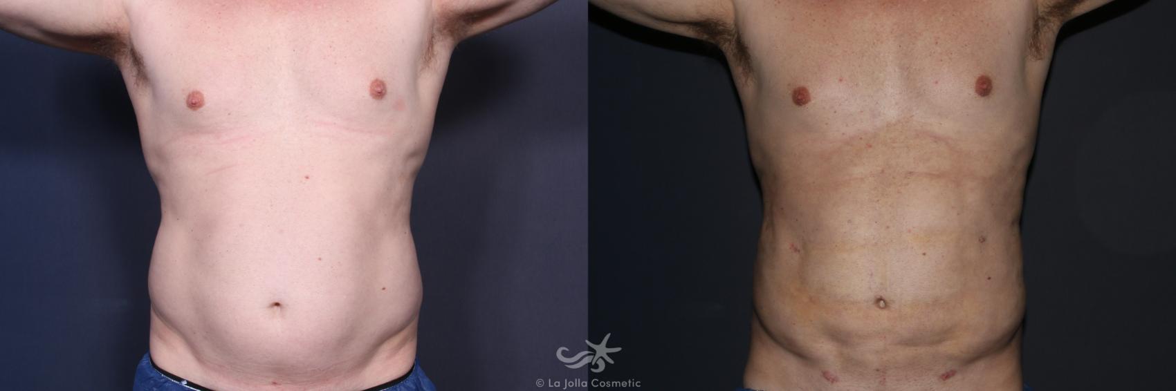 Before & After Male Liposuction Result 132 Front View in San Diego, CA