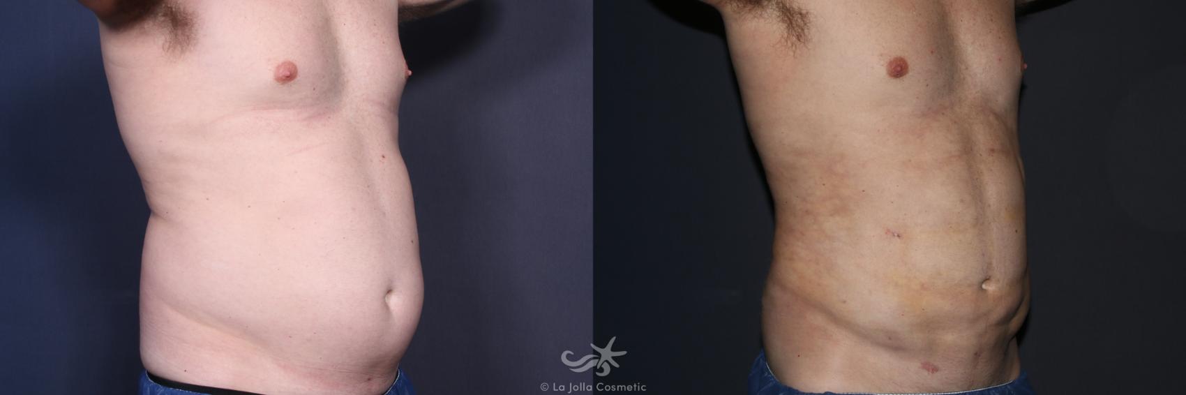 Before & After High Definition Liposuction Result 132 Right Oblique View in San Diego, CA