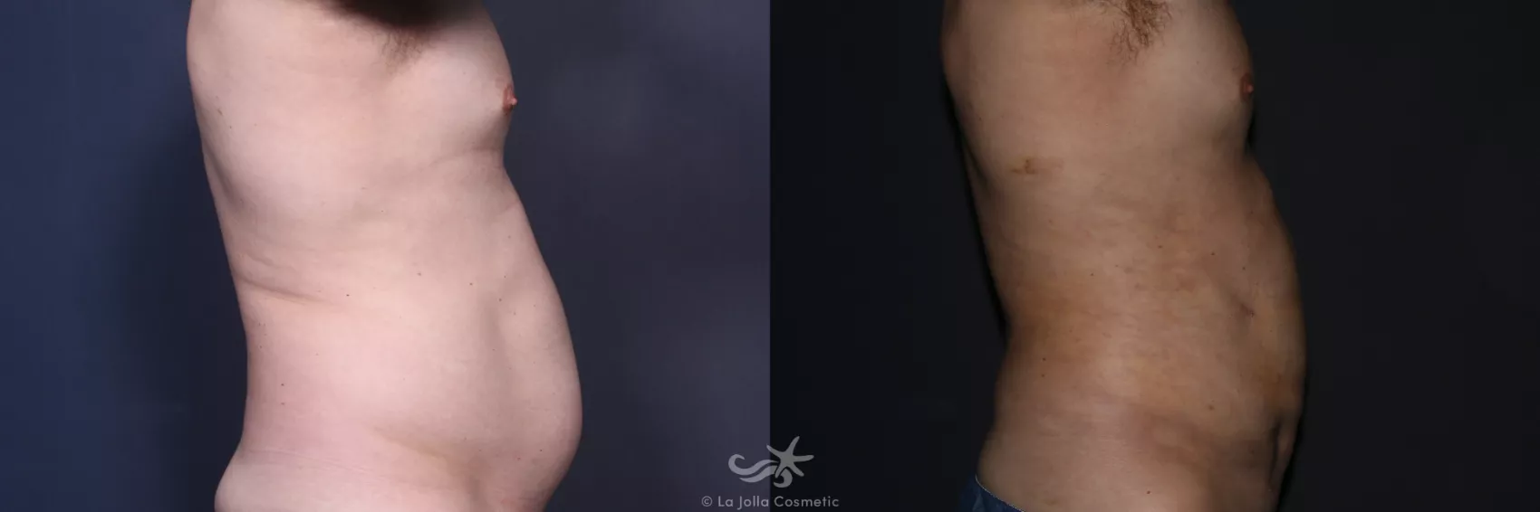 Before & After High Definition Liposuction Result 132 Right Side View in San Diego, CA