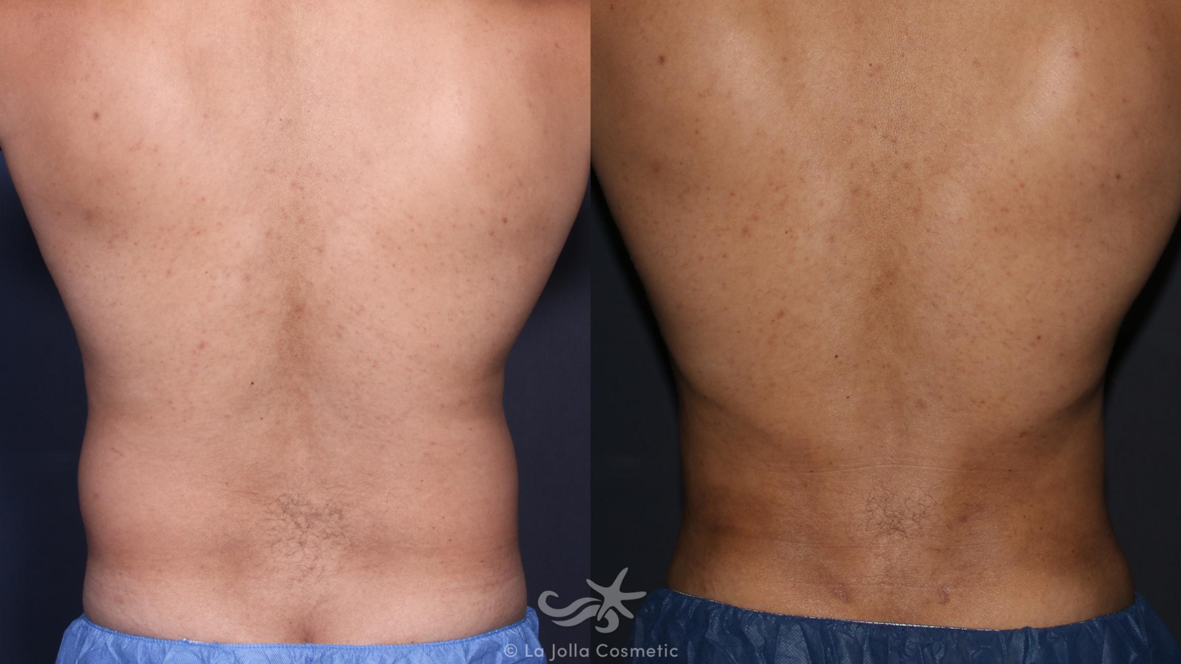 Before & After High Definition Liposuction Result 134 Back View in San Diego, CA