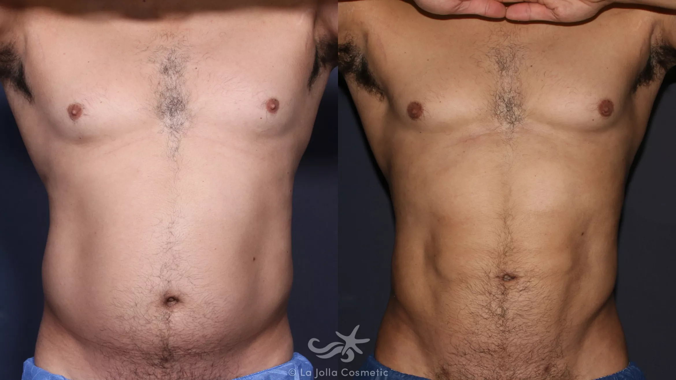 Before & After High Definition Liposuction Result 134 Front View in San Diego, CA