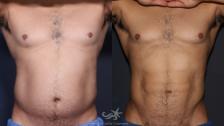 Before & After High Definition Liposuction Result 134 Front View in San Diego, Carlsbad, CA