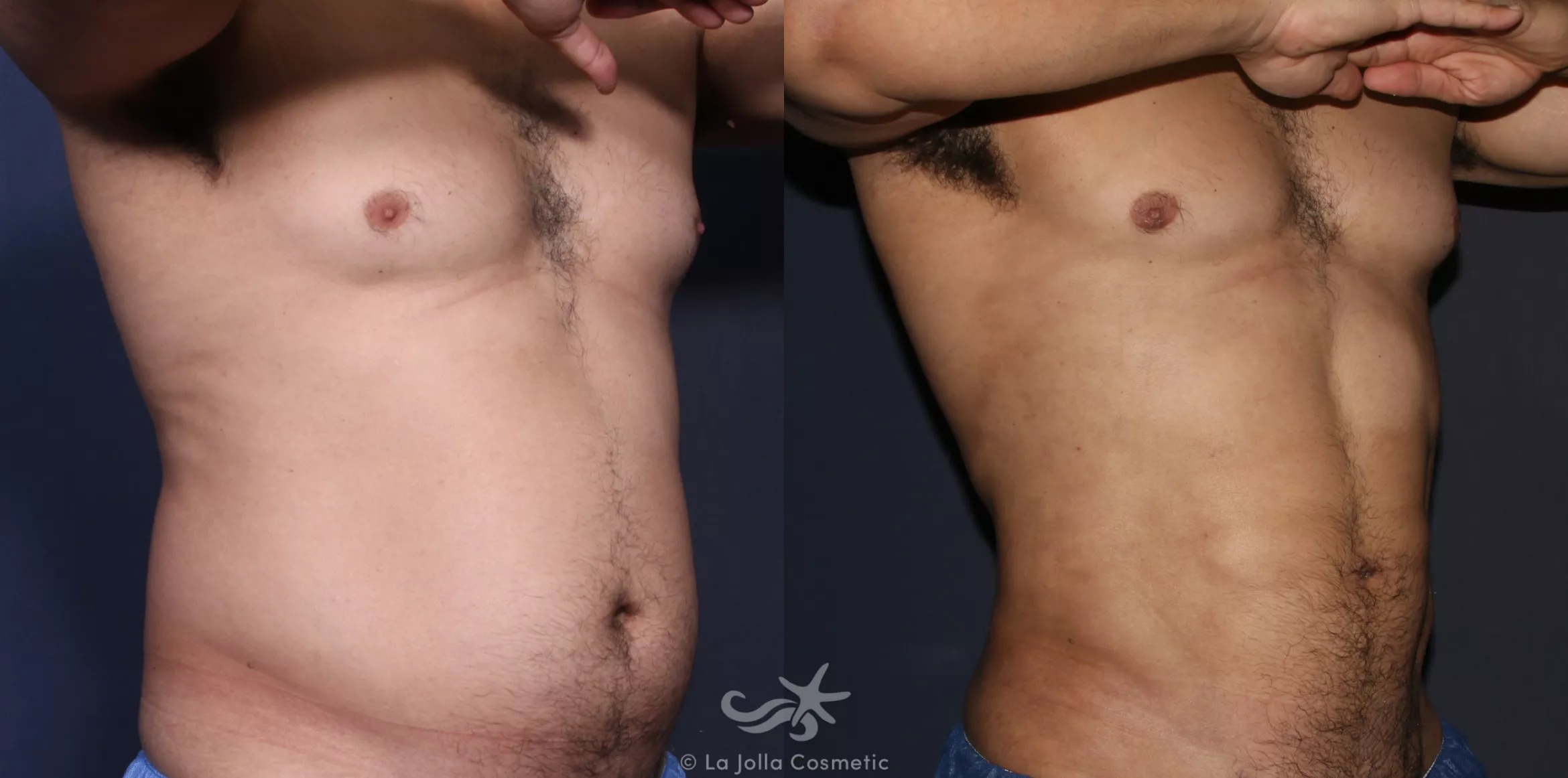 Before & After High Definition Liposuction Result 134 Right Oblique View in San Diego, CA