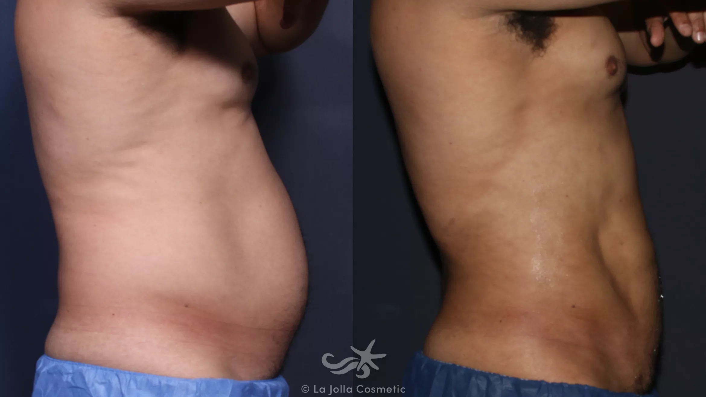 Before & After High Definition Liposuction Result 134 Right Side View in San Diego, CA