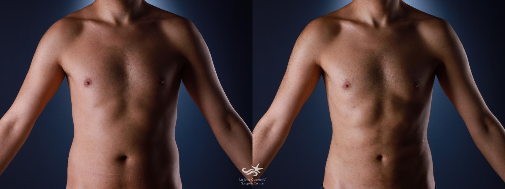Before & After High Definition Liposuction Result 1344 Front View in San Diego, CA