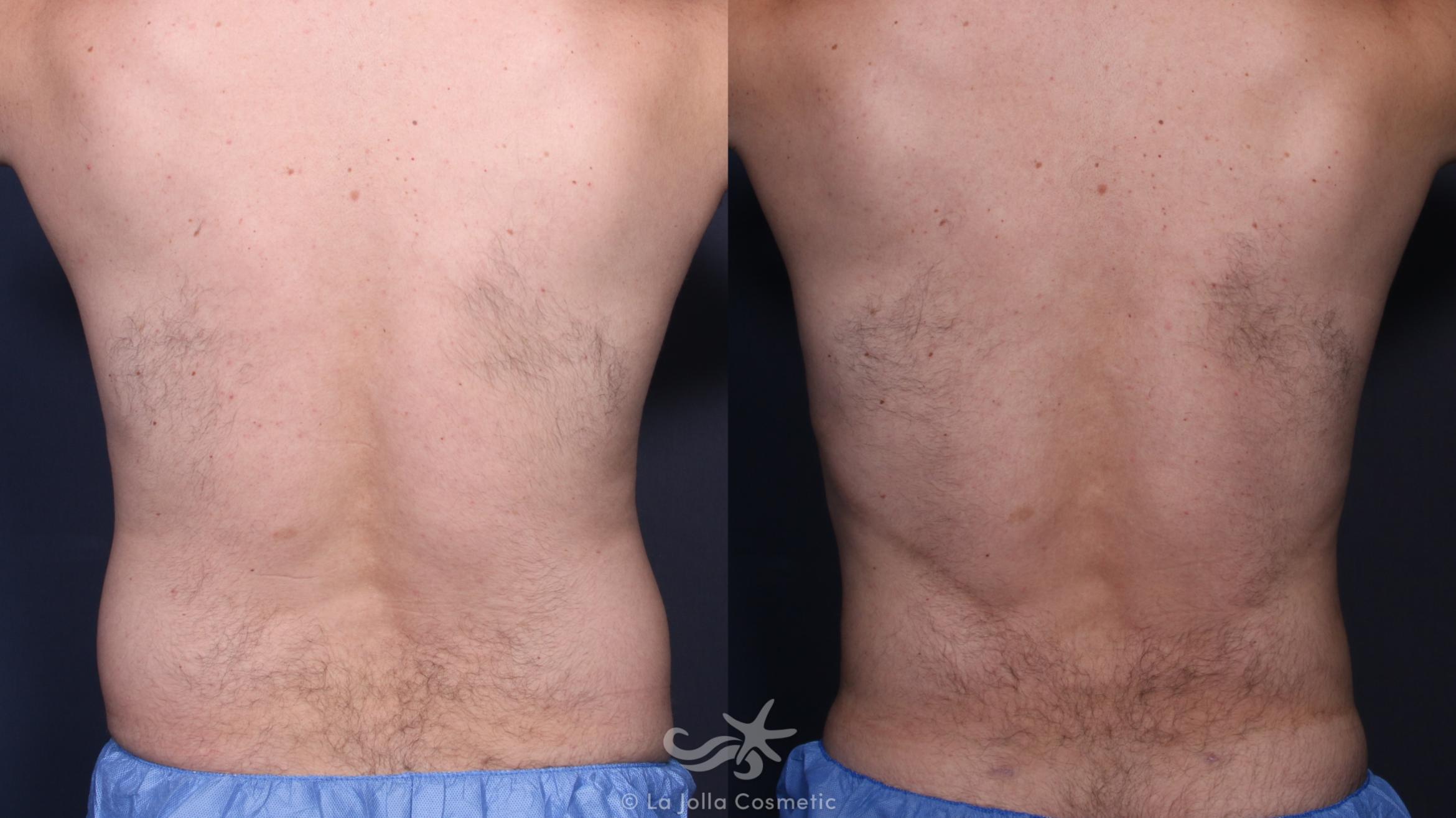 Before & After High Definition Liposuction Result 138 Back View in San Diego, CA