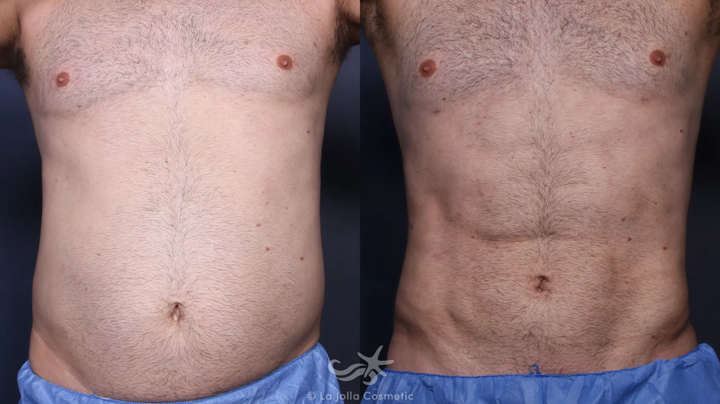 Before & After High Definition Liposuction Result 138 Front View in San Diego, CA