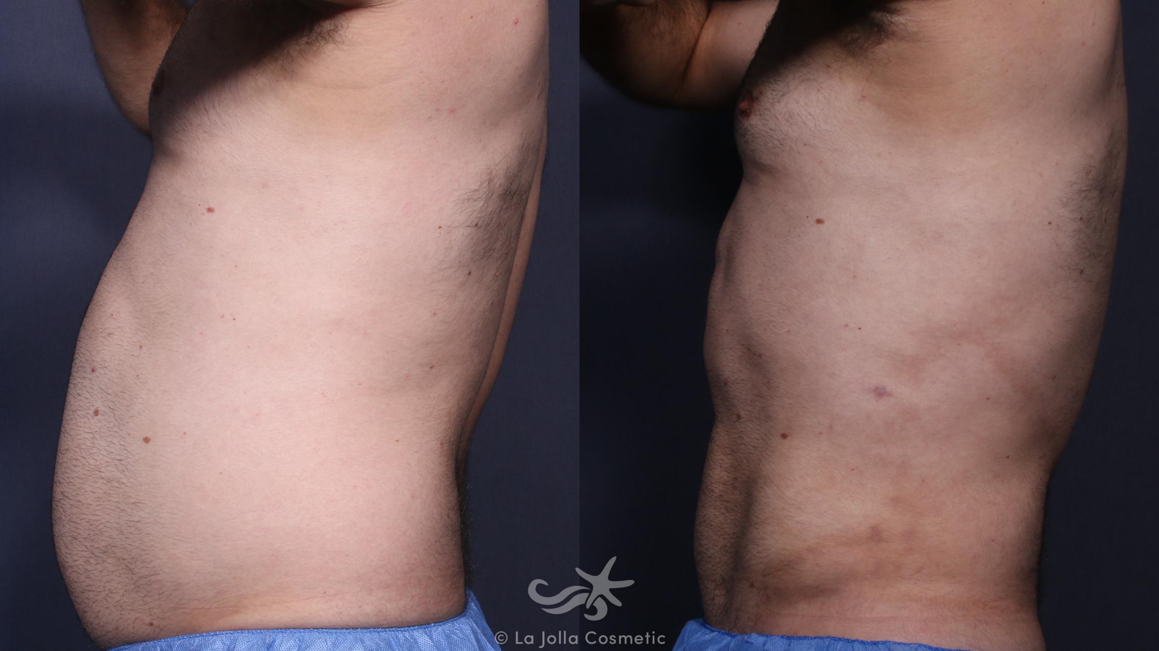 Before & After High Definition Liposuction Result 138 Left Side View in San Diego, CA