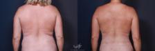 Before & After High Definition Liposuction Result 190 Back View in San Diego, Carlsbad, CA