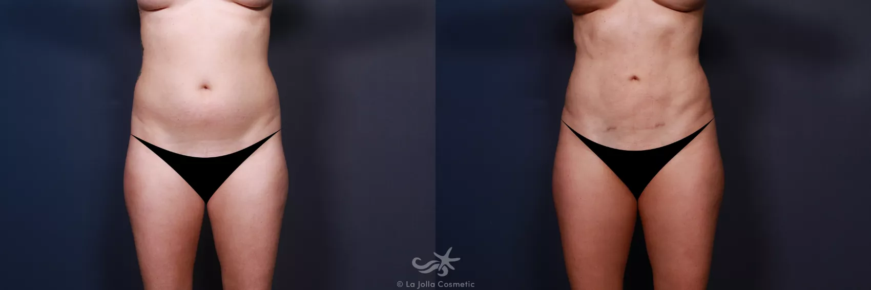Before & After High Definition Liposuction Result 35 Front View in San Diego, CA