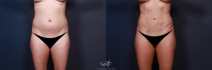 Before & After High Definition Liposuction Result 35 Front View in San Diego, Carlsbad, CA