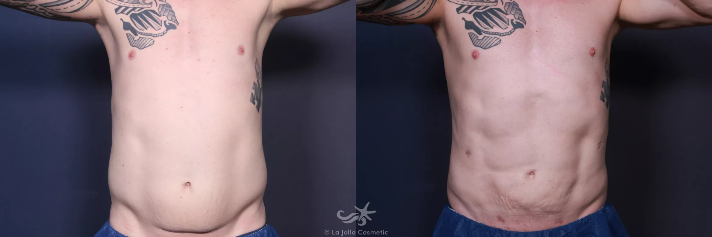 Before & After High Definition Liposuction Result 552 Front View in San Diego, CA