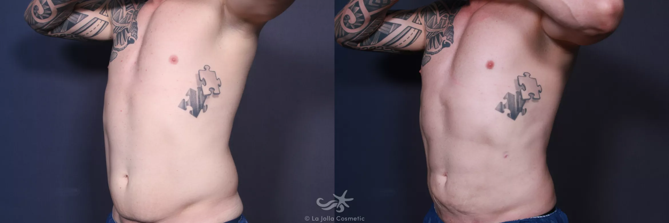 Before & After High Definition Liposuction Result 552 Left Oblique View in San Diego, CA