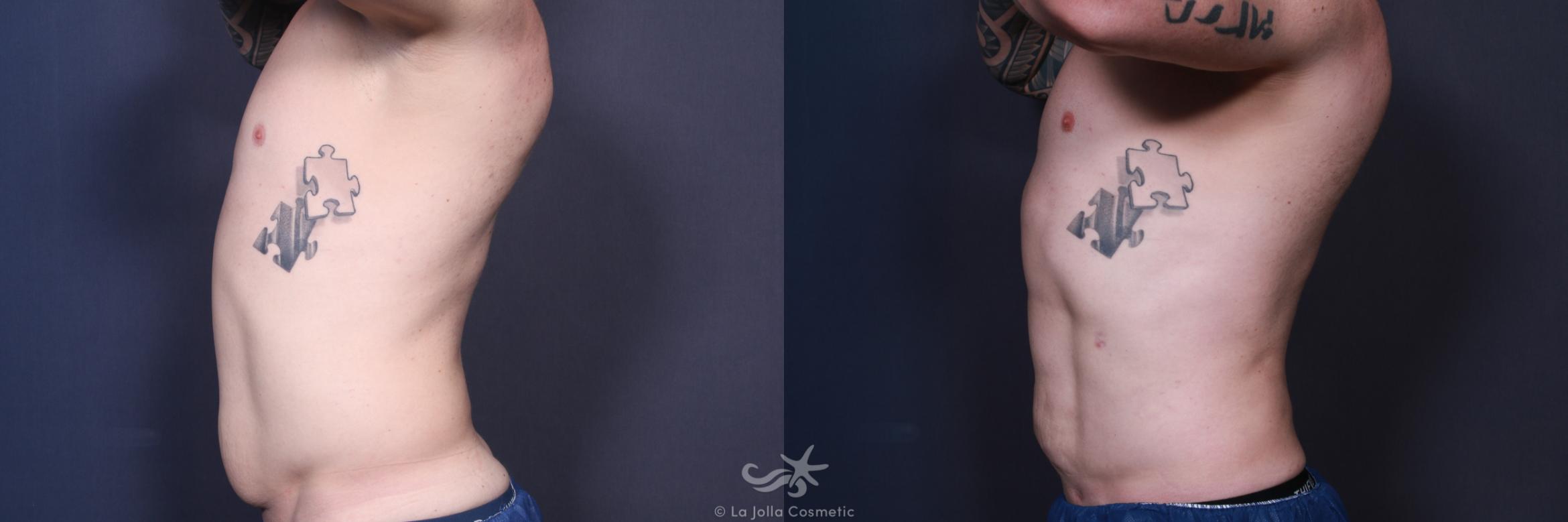 Before & After High Definition Liposuction Result 552 Left Side View in San Diego, CA