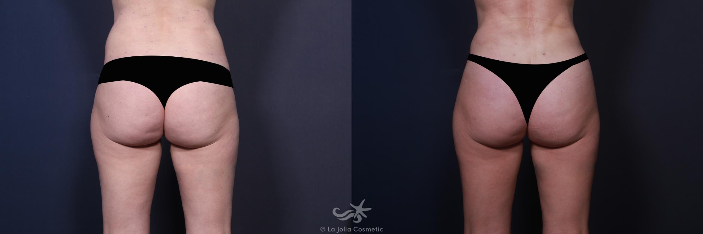 Before & After High Definition Liposuction Result 556 Back View in San Diego, CA