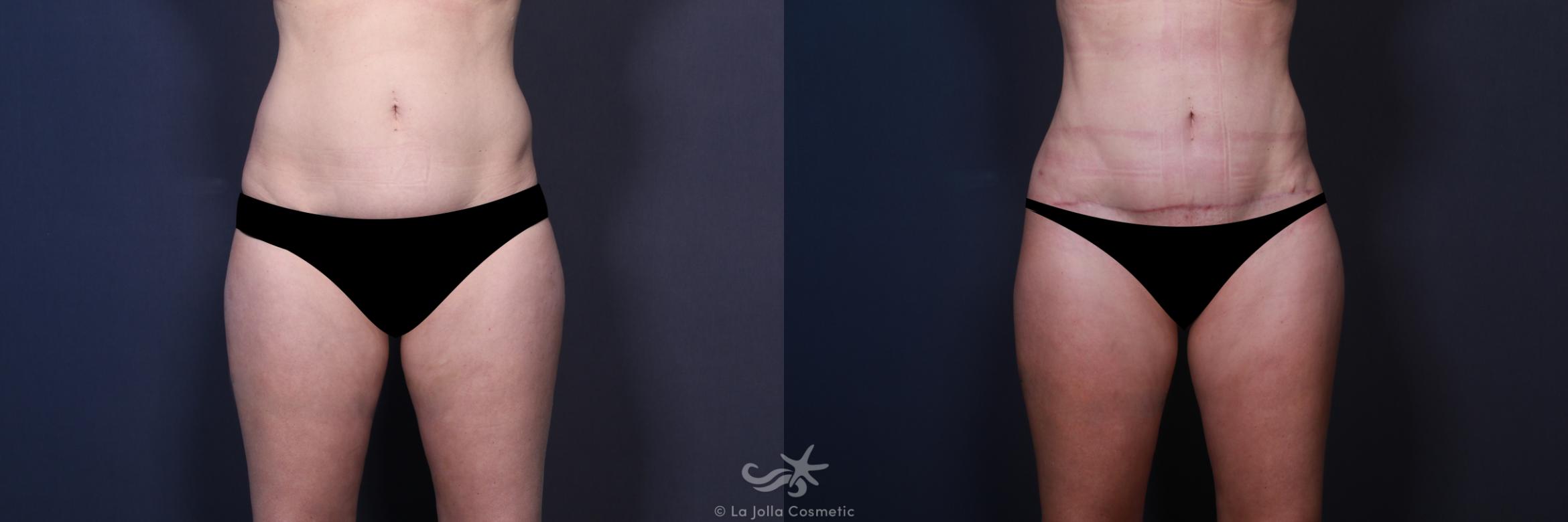 Before & After High Definition Liposuction Result 556 Front View in San Diego, CA