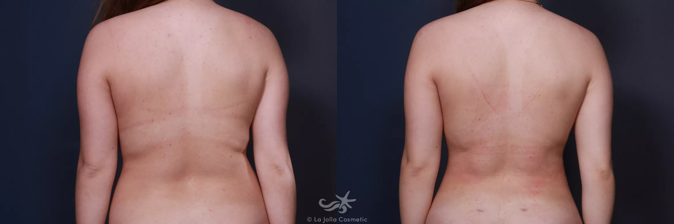 Before & After High Definition Liposuction Result 570 Back View in San Diego, CA