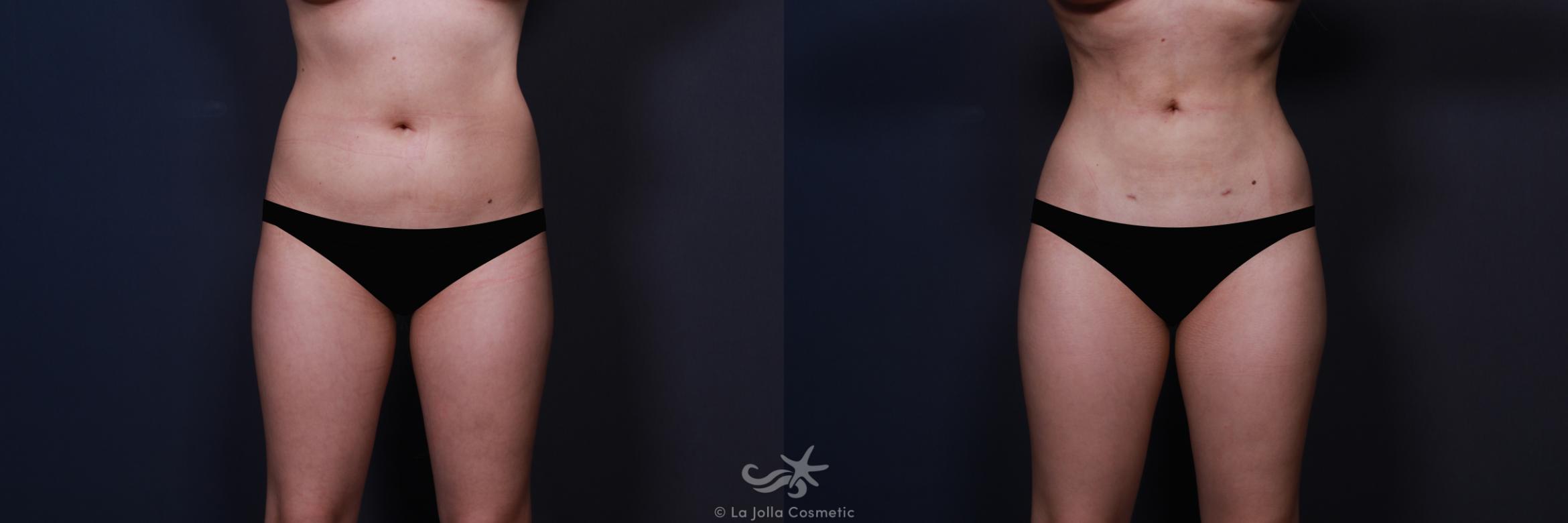 Before & After High Definition Liposuction Result 570 Front View in San Diego, CA