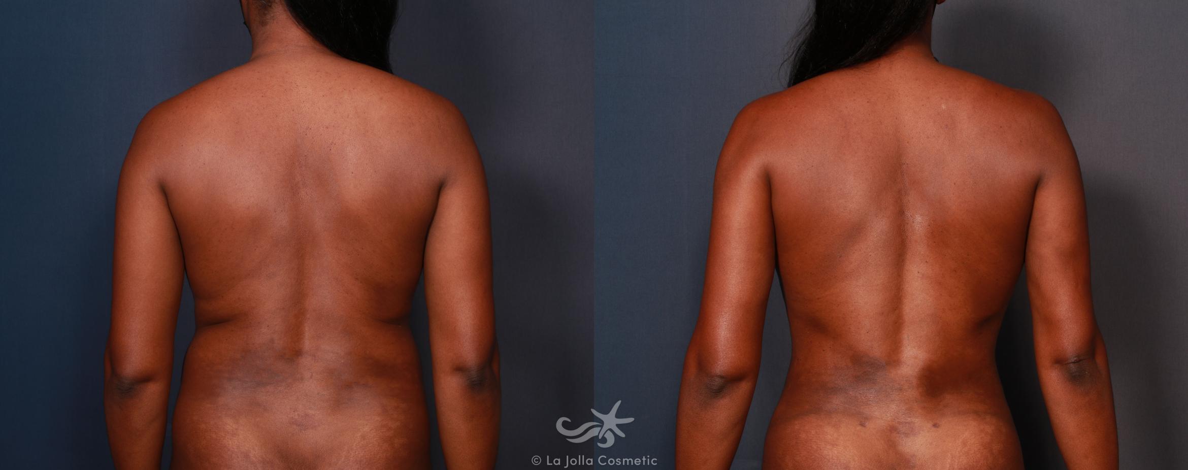 Before & After High Definition Liposuction Result 577 Back View in San Diego, CA